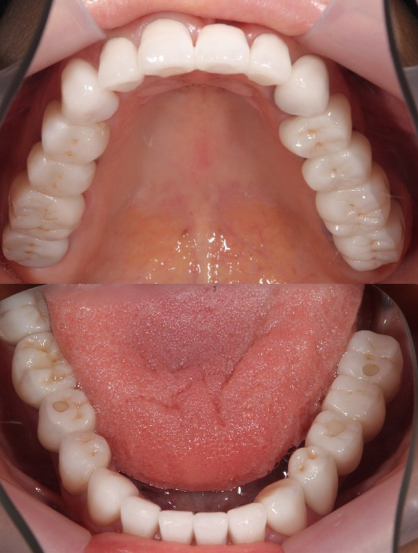 オールセラミック施術後