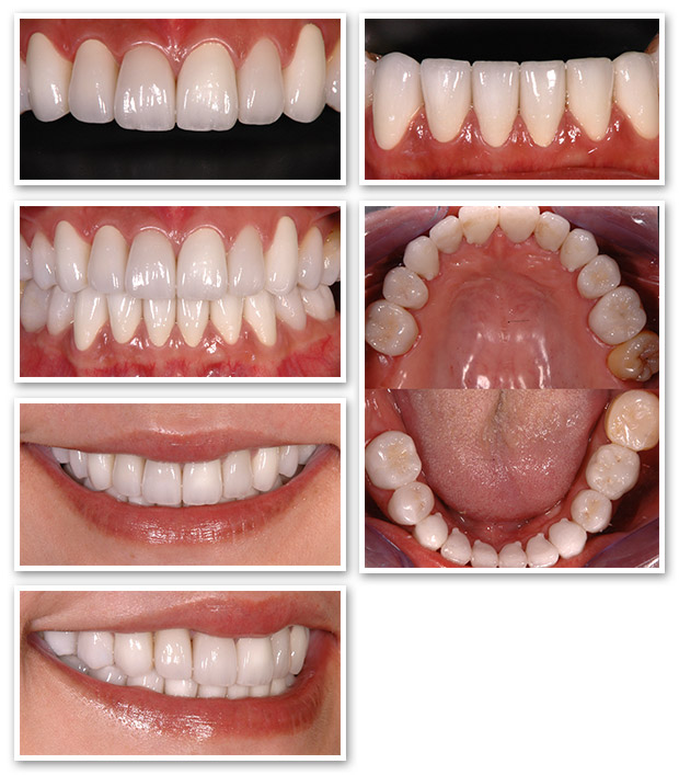 オールセラミック術後